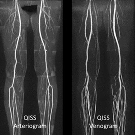 mr bilateral lower limb angiography test